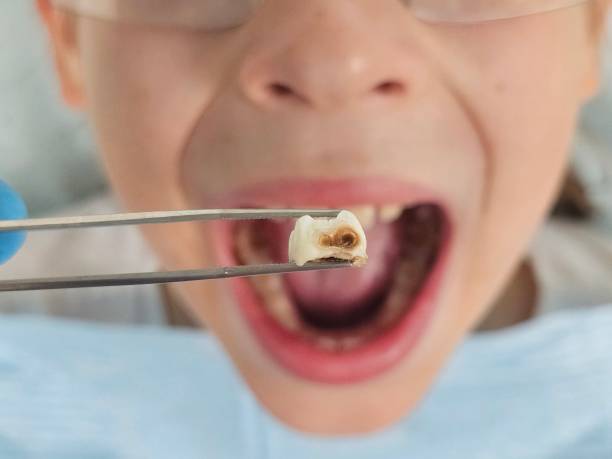 Best Tooth Infection Emergency Dentist  in Fort Polk North, LA